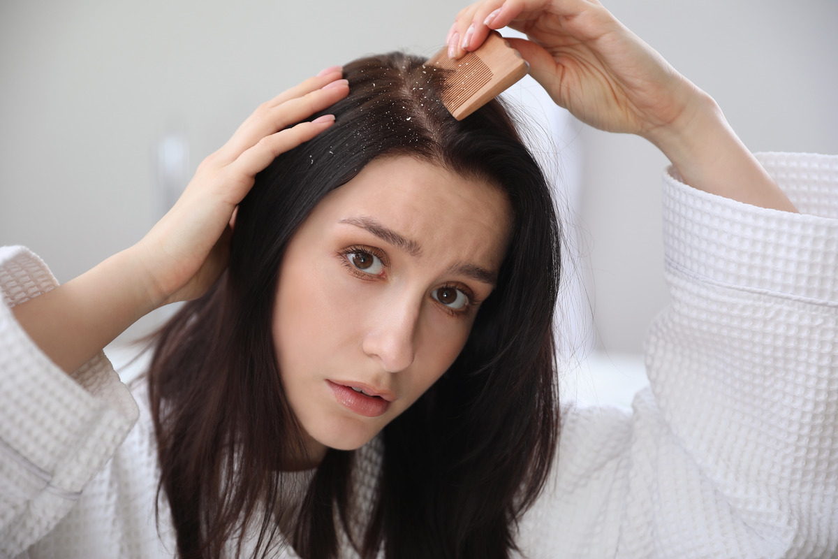 Young woman problem dandruff in hair